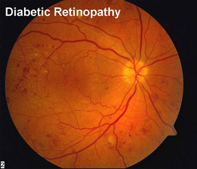 Retina Test, Fundus Checkup, Dilated test, Diabetes in retina